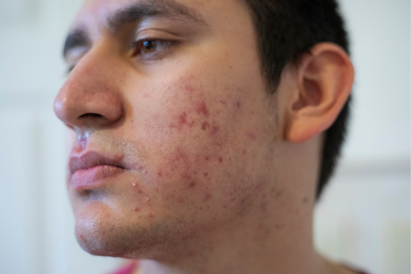 Cơ chế hình thành mụn trứng cá