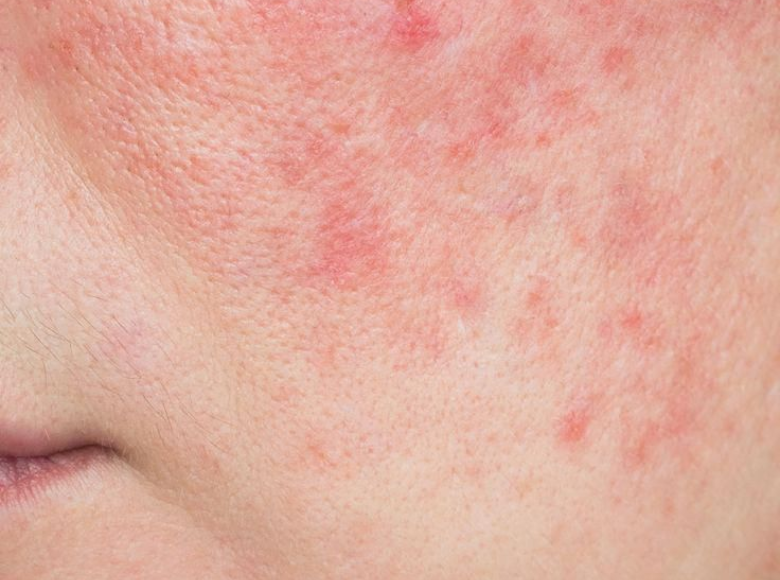 Da nhiễm corticoid là gì? Nguyên nhân và cách phục hồi hiệu quả
