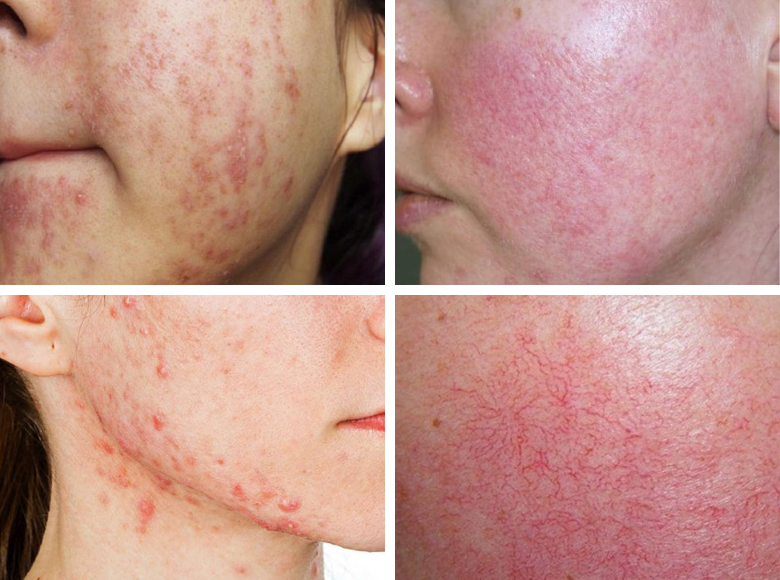 Biểu hiện da mặt bị nhiễm corticoid